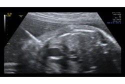 Operasi Jantung Janin Usia 25 Minggu, Dokter Latihan Pakai Buah Anggur