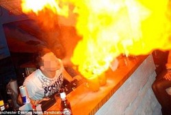 Tersembur Api dan Minuman Alkohol, Wanita Ini Alami Luka Bakar Parah