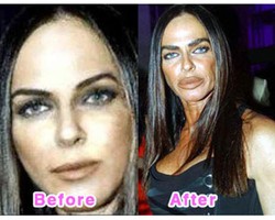 Foto Before-After Wanita-wanita yang Gagal Operasi Plastik 