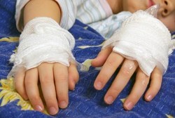 Begini Pertolongan Pertama yang Tepat untuk Atasi Luka Bakar