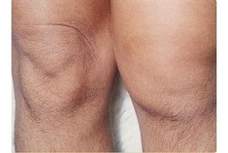 Agar Bisa Gerak, Sejak Balita Perempuan Ini Harus Konstan Ganti Sendi