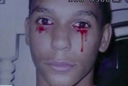 Kena Penyakit Misterius, Calvino Mengeluarkan Air Mata Darah