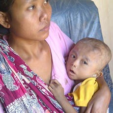 Batita Gizi Buruk Asal Tuban Meninggal Dunia