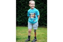 Bocah yang Kehilangan Kaki Karena Kanker Langka Ini Akhirnya Diberi Kaki Robot