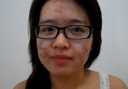 Wow, Wanita dengan Jerawat Meradang Ini Buat Wajahnya Mulus Seketika