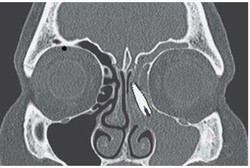 Waduh, Implan Gigi Wanita Ini Malah Nyangkut di Lubang Hidung