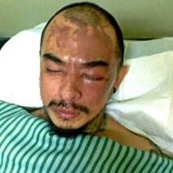 Ini Kondisi Wajah Barry Saint Loco Usai Disiram Air Keras