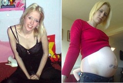 Wanita Ini Kerap Dikira Hamil, Padahal Perut Membesar karena Sakit Langka