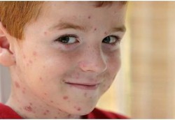 Anak yang Pernah Kena Cacar Air Juga Berisiko Stroke?