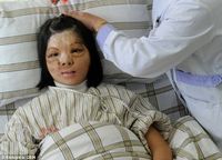  Usai Transplantasi Wajah, Ini Senyum Pertama Xu dalam 12 Tahun Terakhir 