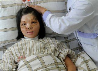  Usai Transplantasi Wajah, Ini Senyum Pertama Xu dalam 12 Tahun Terakhir 