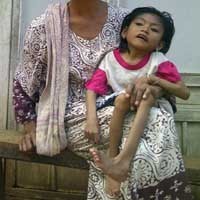 Luluk, Bocah Penderita Gizi Buruk di Tuban Butuh Bantuan Pengobatan