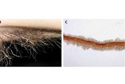 Terinfeksi Bakteri, Rambut Ketiak Pria Ini Jadi Menguning dan Bau