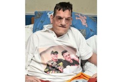 Idap Sindrom Langka, Tulang Pria Ini Tak Berhenti Tumbuh