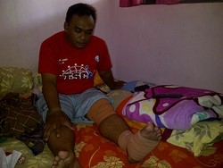 Ditabrak Anggara Pakai Jazz, Setyo Kini Mesti Berjalan dengan Tongkat