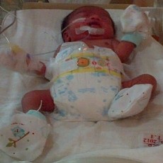 Ibu Bayi Tanpa Usus Besar: Andai Badan Saya Bisa Ditukar dengan Anak Saya