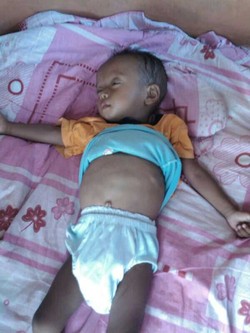 Butuh Pertolongan, Balita Iqbal di Serang Terserang Busung Lapar