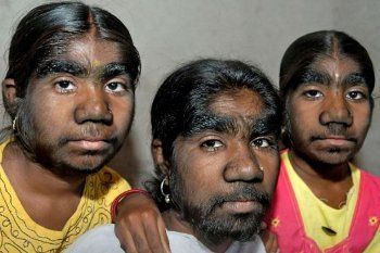 Inilah Keluarga Manusia Serigala yang Sekujur Tubuhnya Penuh Bulu