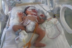 Bisakah Bayi Rafi yang Tak Punya Usus Besar Diobati di Singapura?