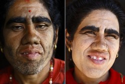 Sekujur Tubuh Penuh Bulu, Keluarga Manusia Serigala Jalani Terapi Laser