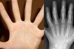 Jago Mengetik Karena Punya 12 Jari, Pria Ini Malah Susah Cari Kerja