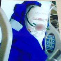 Luka Bakar di Wajah Mahasiswi Binus yang Disiram Air Keras Sangat Parah