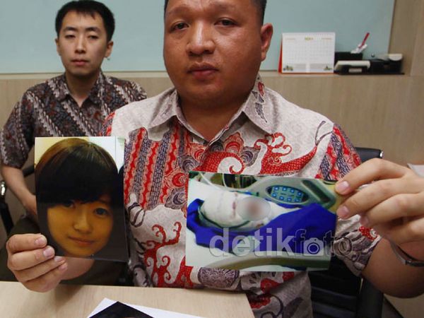 Kondisi Mahasiswi Binus Pasca Disiram Air Keras