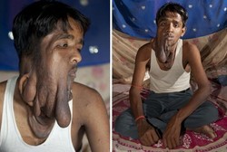 Pria Berwajah Melorot karena Tumor Besar Tumbuh di Muka