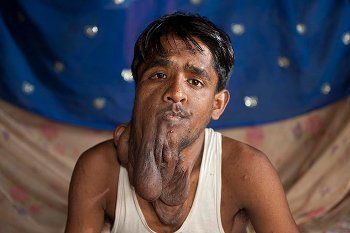 Lalit Ram, Pria Berwajah Melorot akibat Tumor