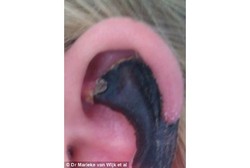 Digigit Laba-laba, Telinga Wanita Ini Menghitam dan Nyaris Putus