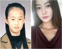 Foto: Perubahan Drastis Wajah Orang Korea Setelah Operasi Plastik