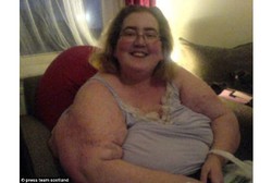 Bobot Tak Bisa Turun Padahal Makan Sedikit, Ternyata Wanita Ini Punya Tumor