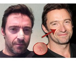 Hugh Jackman Didiagnosa Kena Kanker Kulit Ganas 