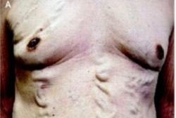 Bukan di Kaki, Pria Ini Punya Varises di Dada Akibat Penyakit Langka