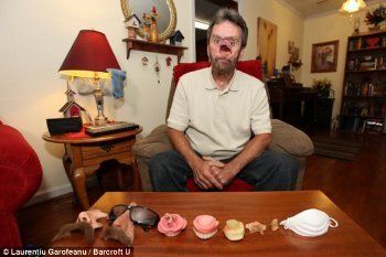 Donnie Fritts, Pria Berwajah Bolong dan Tak Punya Hidung