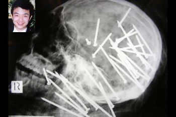 Seramnya Penampakan Benda-benda Tajam yang Bersarang di Tubuh