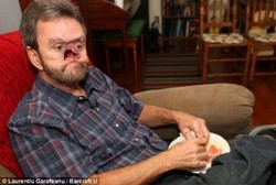 Kisah Pria Tanpa Hidung, Wajahnya Berlubang Besar karena Kanker Langka