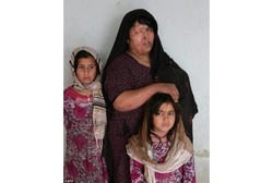 Perempuan Ini Kehilangan Separuh Wajahnya Gara-gara Disiram Air Keras