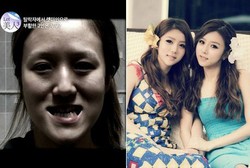 Operasi Plastik Total, si Kembar Kini Jadi Putri Cantik Jelita