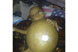 Agar Tak Terlambat Seperti Akilah, Amati BAB Warna Dempul pada Bayi