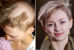 Gadis Cantik Ini Berkepala Botak karena Hobi Tarik-tarik Rambut Sendiri