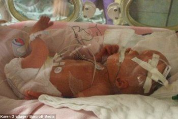 Inilah Kaydence Theriault, Bocah dengan Bentuk Kepala Tak Beraturan