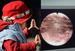 Gatal, Telinga Balita Ini Ternyata Ditumbuhi Dandelion