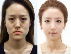 Cantik! Wajah Saudara Kembar Ini Berubah Drastis Pasca Operasi Plastik