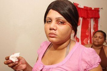 Delfina Cedeno, Gadis Berpenyakit Aneh yang Menangis dan Berkeringat Darah