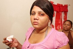 Kena Penyakit Aneh, Delfina Menangis dan Berkeringat Darah