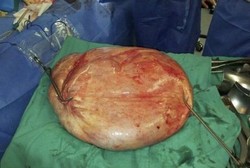 Dikira Obesitas, Ternyata Ada Tumor Raksasa di Perut Wanita Ini