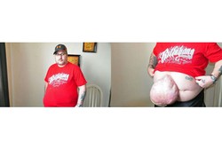 Luka Bekas Operasi Kecelakaan Pria Ini Jadi Hernia Seberat 12 Kg