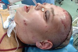 Wajah Berantakan karena Tumor, Wanita Ini Akhirnya Dapat Transplantasi