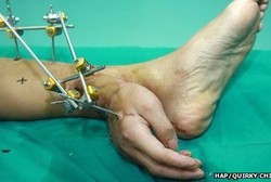 Putus Akibat Kecelakaan Kerja, Tangan Pria Ini Ditanam di Kaki Kiri